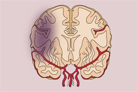头部血管堵塞的十大征兆，脑血管堵塞的症状有什么
