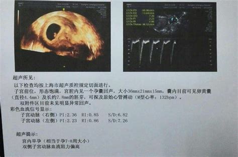 看下这三张图，后两张是吸氧后的 感觉胎动少，测胎心120多，以前一直是140左右，做了第一张胎心监护的图 - 百度宝宝知道