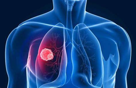 肺癌的早期征兆-尚医健康