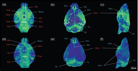 一种人脑胶质瘤小鼠原位模型的构建方法与流程