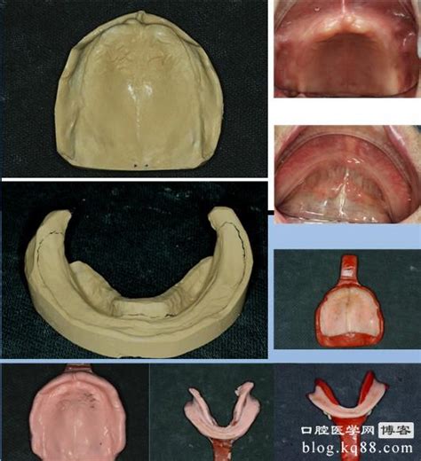 HCH全口义齿病例展示附视频-宁波朱静峰的博客-KQ88口腔博客