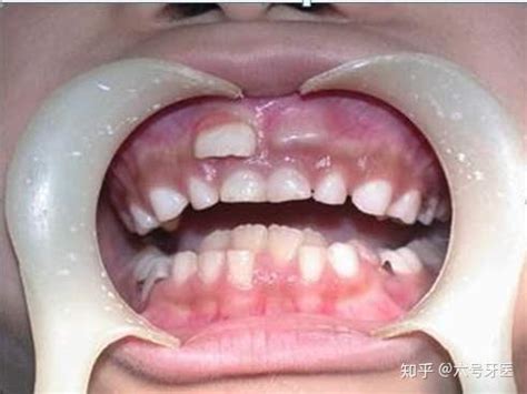 怎样的牙齿是好看的牙齿？牙齿成长过程应注意那些方面防止牙齿长丑？ - 知乎