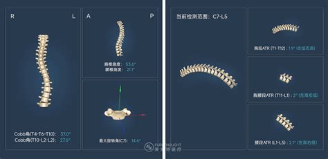 科学网—基于机器学习和几何变换的实时2D/3D脊椎配准 - 欧彦的博文