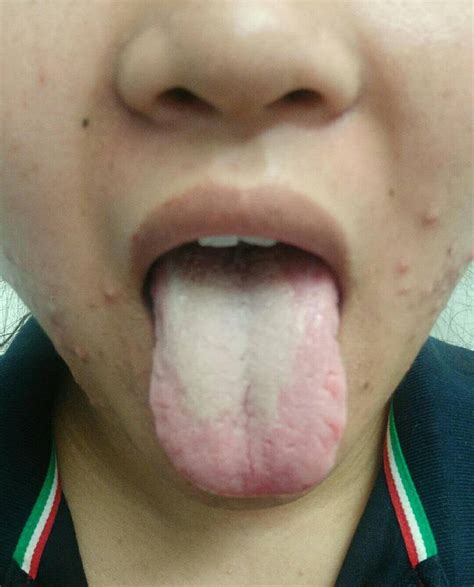湿热舌头症状图片