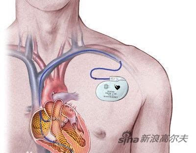 安装心脏起搏器有哪些优劣之处_酷知经验网