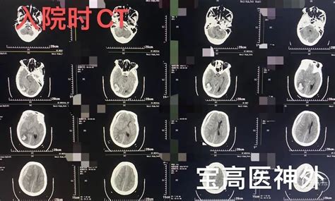 以皮质表面铁沉积为影像特征的脑淀粉样血管病临床特点分析 - 中华医学杂志