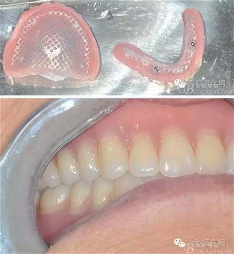 分享我制作活动义齿案例2（全口义齿）-英国假牙师的博客-KQ88口腔博客