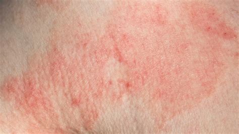 梅毒疹的好发部位有哪些 这4个部位出现湿疹要多加注意-梅毒概况-复禾健康