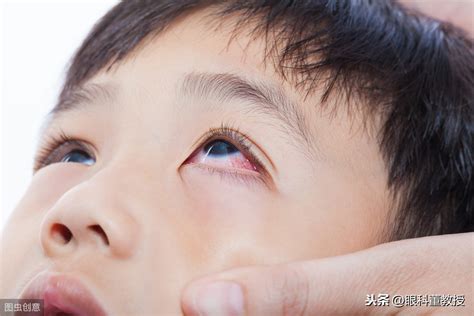为什么宝宝会得红眼病_孩子为什么会得红眼病 - 育儿指南