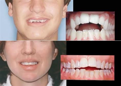 top-9-牙齿缝隙，磨牙锁颌，隐形矫正-张世伟的博客-KQ88口腔博客