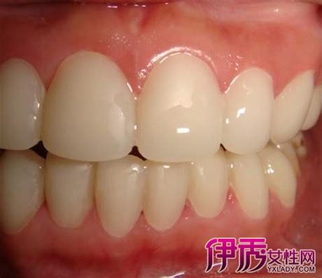 【牙齿松动是什么原因】【图】牙齿松动是什么原因 只需3步即可助你告别困扰_伊秀健康|yxlady.com