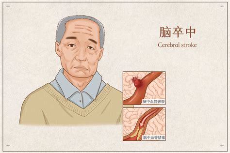 手部常见运动系统疾病康复——脑卒中后手功能康复 - 微医（挂号网）