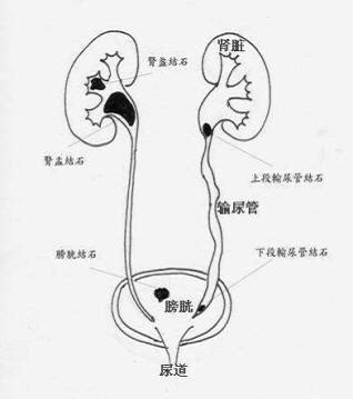 肾结石疼痛位置图图片