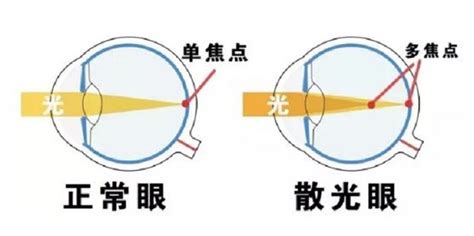 眼科医生杨羿：幼儿园体检发现孩子有散光，一定要配眼镜吗？_屈光