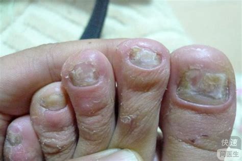 灰指甲的感染因素有哪些？ - 知乎