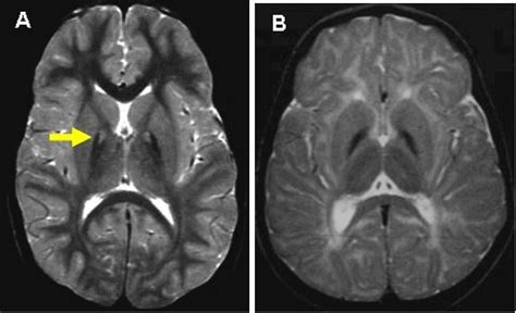 Figure 1. [T2-weighted brain MRI of PKAN (A) and non-PKAN NBIA (B ...