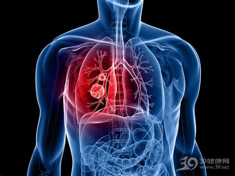这5个肺癌的早期症状容易被忽略！看一眼能救命_39健康网_癌症