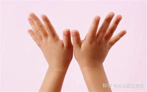 孩子多长了个手指怎么办？多指症如何治疗？ - 知乎