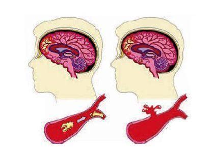 容易发生脑血栓的七个前兆表现