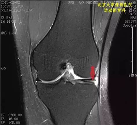 吴恩达团队新研究！用MRNet进行膝关节磁共振影像诊断 已媲美医生 | 论文 - 知乎