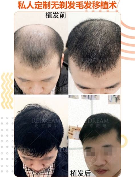 晒几张我在北京雍禾植发际线和头发加密10个月后的图片_北京雍禾植发发际线案例 - 毛毛网