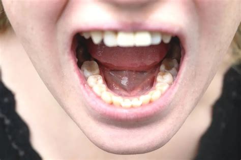 舌头有白点，误以为口腔溃疡，医生：可能是口腔癌早期信号_凤凰网健康_凤凰网