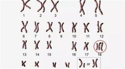 18号染色体异常六大类型：微重复、缺失对胎儿影响大-孕多多