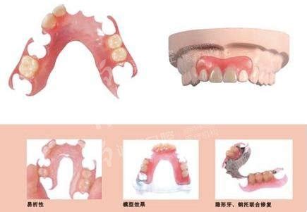 活动假牙的种类及价格详细介绍-附活动义齿利与弊(优缺点) - 口腔资讯 - 牙齿矫正网