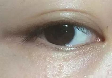 眼睛周围湿疹图片