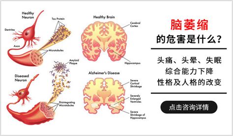 老人患上大脑萎缩的危害是什么_上海蓝十字脑科医院_同济大学附属脑科医院（筹）