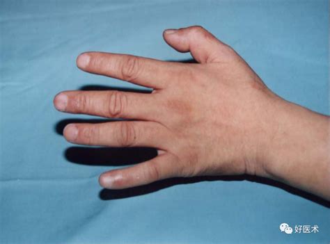手指麻木，爪形手畸形，出现这些症状一定要小心-医院汇-丁香园