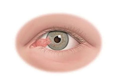 眼睛胬肉早期图片