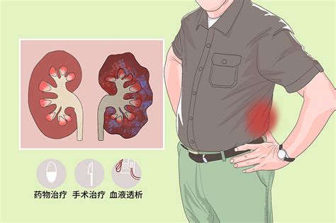 【世界肾脏病日】9招助你预防慢性肾病 - 青岛新闻网
