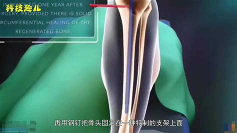 医学3D动画演示：胫骨高位截骨术治疗膝内翻_腾讯视频