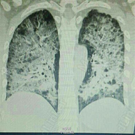肺结核的早期症状ct图 (61)_有来医生