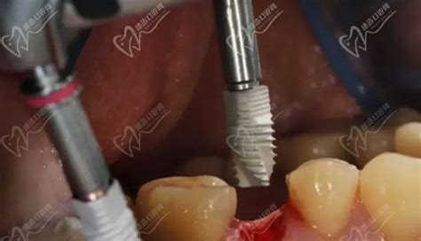 种植牙一期二期三期流程图，看完就明白种牙需要去几次医院_皓齿口腔网