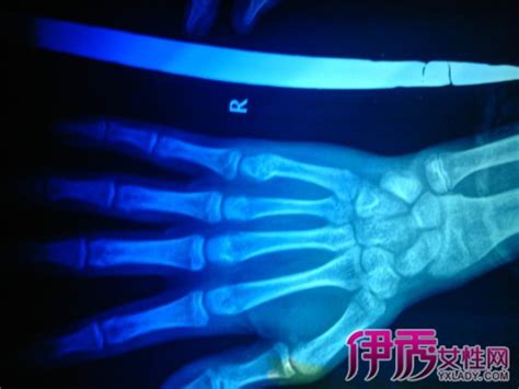 中华医学会核医学分会 病例报告 （207号）半肢骨骺发育异常一例