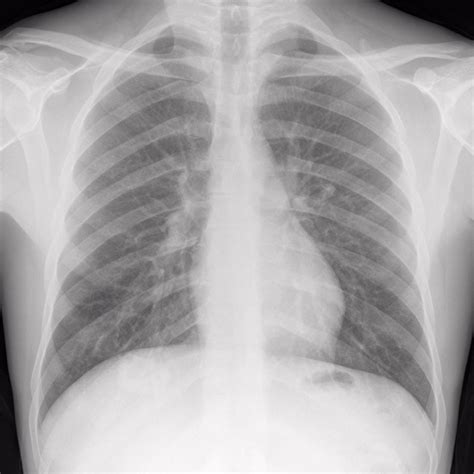 人胸部或肺部x光片显示正常肺。
