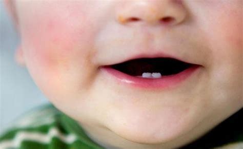 小宝宝出生就有牙，是小天才，还是补多了钙，为什么有的要拔掉？