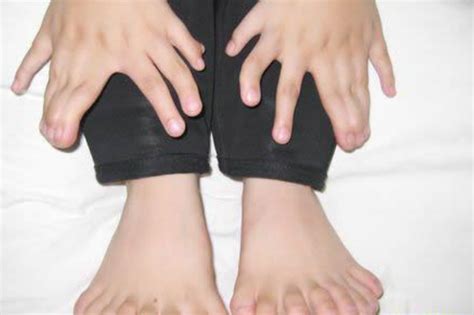 世界上手指脚趾最多的人:印度男孩多指畸形(34根手脚指)_探秘志