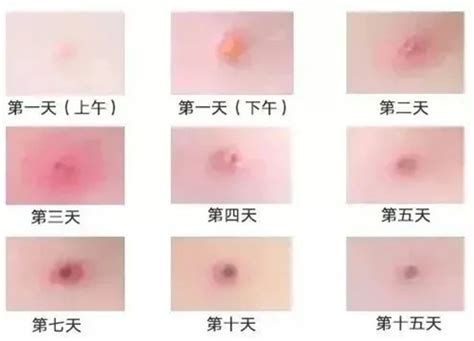 一个中医爱好者告诉你痘痘的各种类型，以及应对办法-教育资讯协会