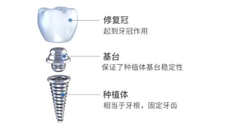 种植牙材质有哪些分类？哪种材质是好的？-爱康健齿科