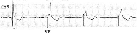 第260例 起搏心律伴窦——室室性融合波-心律失常心电图分析-医学