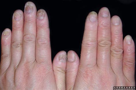 甲病：「灰指甲」有可能是「牛皮癣」_医学界-助力医生临床决策和职业成长