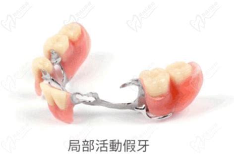 种植牙和活动牙的优缺点（为什么60岁后不种植牙）_多优仕口腔