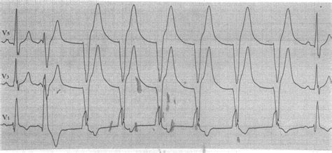 12-6 加速的室性心律-心电图诊断解读-医学