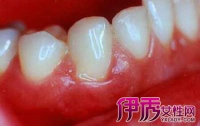 牙龈增生图片