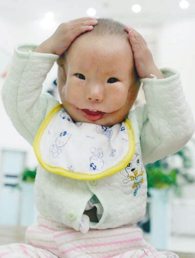 全国儿童耳朵畸形整形医院排名,含北京/上海耳再造口碑医院 - 爱美容研社