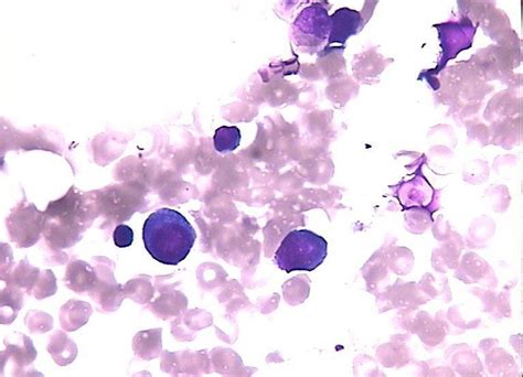 异型淋巴细胞和异常淋巴细胞 - 临床检验 -丁香园论坛