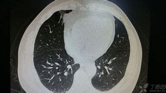 肺纤维化的ct表现有哪些-肺纤维化检查-复禾健康